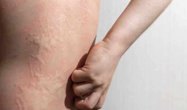 Kid with an aggressive form of hives, nettle rash on back. Child with inflamed ear on white background scratching skin. Red, itchy welts common in children's allergic skin reactions.