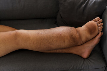 Close Up Of Unrecognized Male With Severely Swollen Leg Resting On Sofa