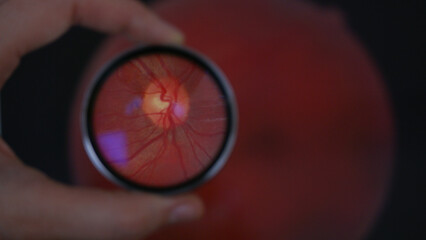 View of optic disc during examination of retina while holding 20 diopter lens. A routine fundus...