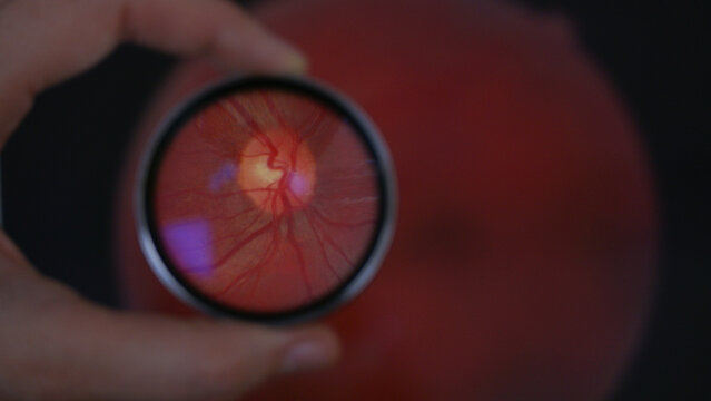 View of optic disc during examination of retina while holding 20 diopter lens. A routine fundus screening method during eye exam.