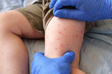 Doctor examining child with bodily red rash. Kid allergy closeup. Little baby scratches an...