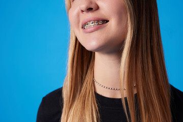 Woman is showing her teeth with braces, close-up. Smile with braces, side view. Orthodontic...