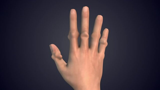 Swollen Synovial Cavity With Inflammatory Tissue