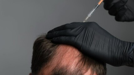 Mesotherapy for hair. A man undergoes a mesotherapy session in a beauty salon, the therapist in a protective glove with a syringe. Baldness and hair loss.