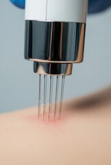 Morpheus 8 is a device for microneedle RF lifting, used in cosmetology for facial and body skin rejuvenation, for the correction of various skin defects. It operates on the basis of fractional microne