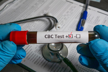 Doctor holding cbc test tube with positive result near stethoscope and medical form