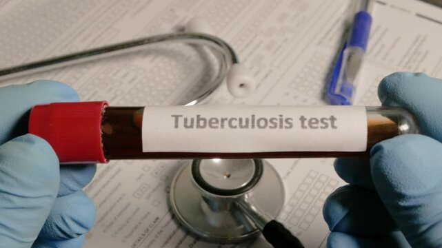 Doctor showing tuberculosis test vial