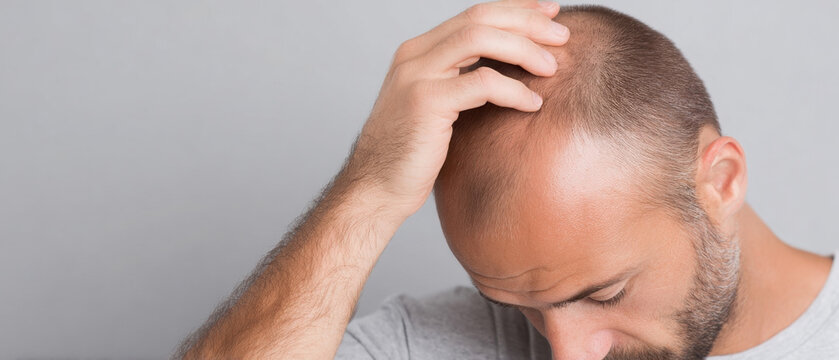 Bald man touching his head in contemplation against a gray background. baldness, hair growth products