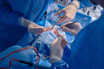 Close Up of Blepharoplasty Surgery Performed by Surgeons in Modern Clinic Operating Room