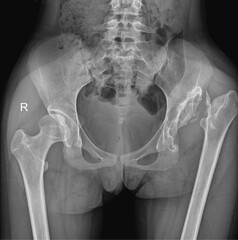 AP view of the pelvis