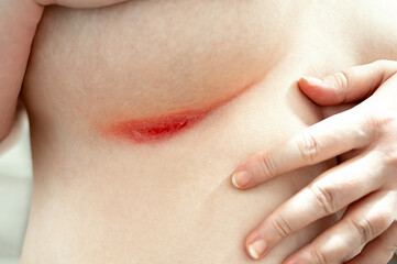 Close-up of severe red rash in breast fold. Intense skin irritation with visible damage and pain
