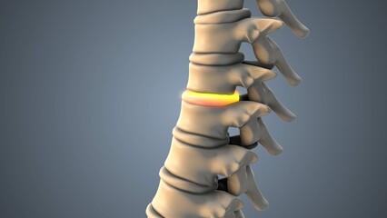 Skeletal Spine Intervertebral Disc Herniation with Radiating Pain