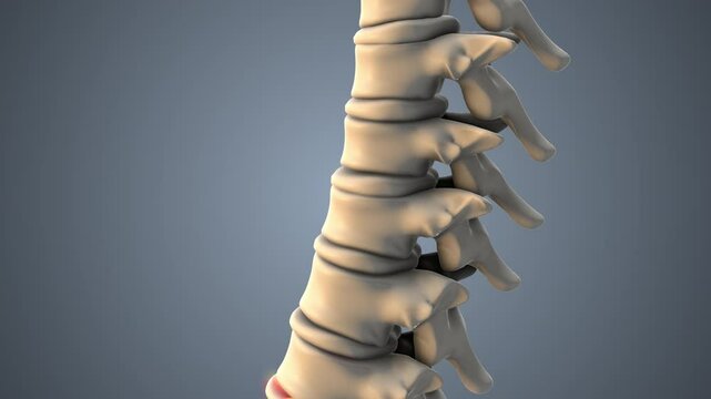 Skeletal Spine Intervertebral Disc Herniation with Radiating Pain