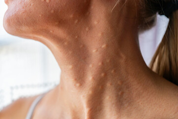 Woman's face after mesotherapy injections biorevitalization. beauty injections. High quality photo