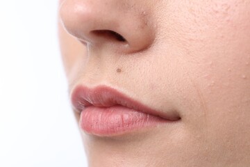 Woman with mole on her face against white background, closeup