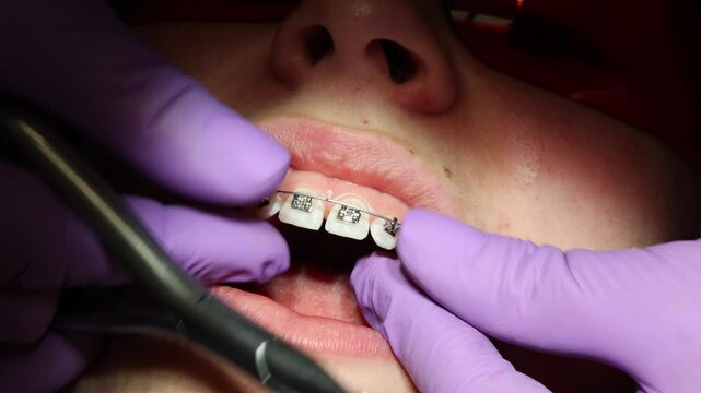 Orthodontist Adjusting Ceramic Braces on Patient Teeth, Close-up video of an orthodontist adjusting clear ceramic braces on a young patient's upper teeth during dental treatment. 