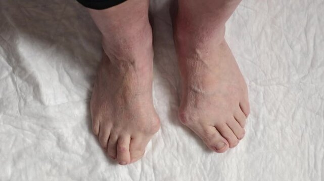 Two feet of an elderly woman with hallux valgus.