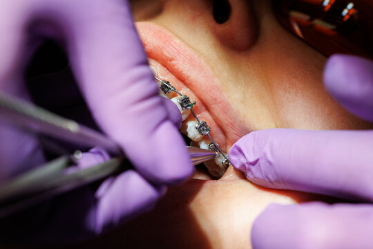 Orthodontist Adjusting Ceramic Braces on Patient Teeth, Close-up , of an orthodontist adjusting clear ceramic braces on a young patient's upper teeth during dental treatment. 