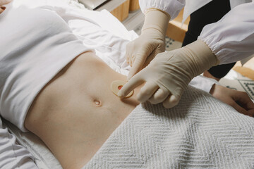 A nurse applies a sticky circle to a patient's colostomy bag.