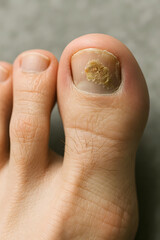Close-Up of Fungal Toenail Infection