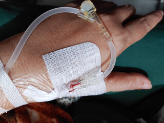 Close up of an Intravenous catheter inserted inside the palm of a patient inside at the hospital
