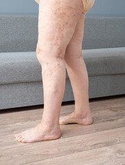 Women's legs with varicose veins