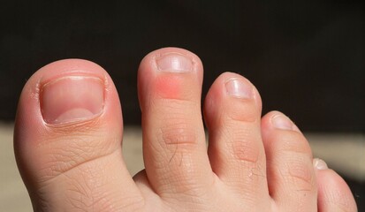 Red and swollen toe with visible nails on foot in sunlight  