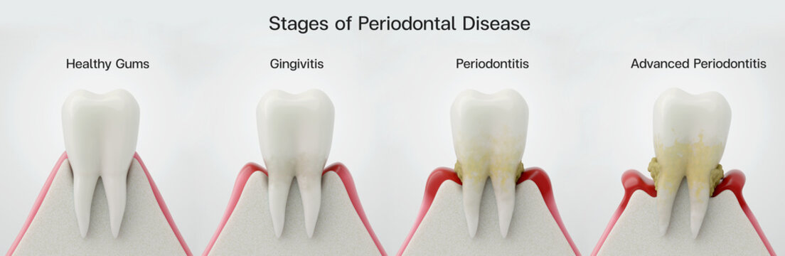 Stages of Periodontontal Disease, from Healthy Gums to Advanced Periodontitis. 3D Infographic.