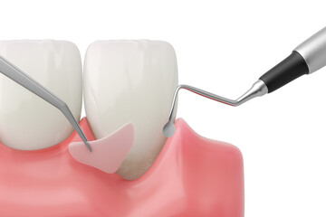Gum Graft Surgery for Periodontitis, Gingival Recession Treatment. 3D Medical Illustration.