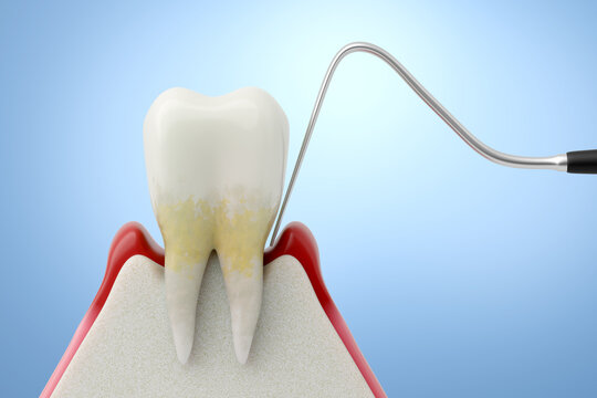 Periodontitis Diagnosis with Periodontal Probe, Dental Examination. 3D Medical Illustration.