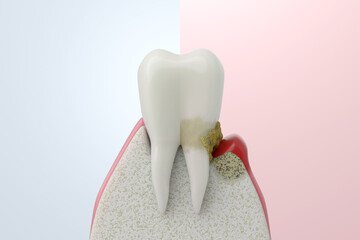 Healthy Gums and Periodontitis Disease Comparison. Dental Health Explainer 3D Render.
