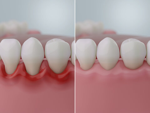 Gum Disease Before and After, Gingivitis vs Healthy Gums. Dental Treatment Comparison. 3D Illustration.