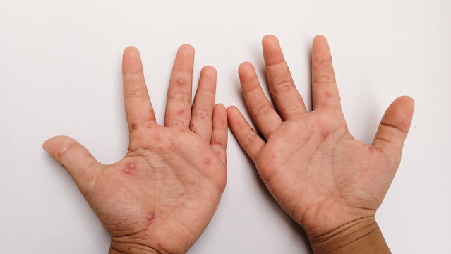 Child's hand with symptoms of  hand, foot and mouth disease or HFMD with red spots and blisters. Viral Diseases. Infectious Diseases. White background