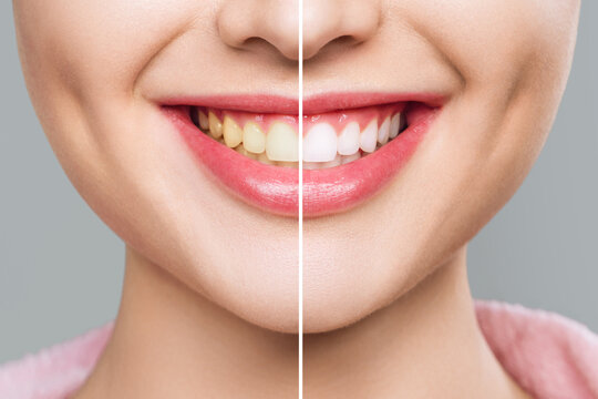 Smile Transformation A Stunning Before and After Journey of Teeth Whitening Process