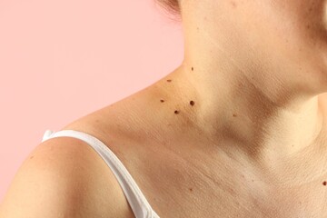 Woman with moles on her skin against pink background, closeup