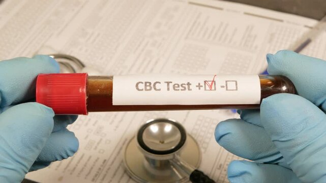 Doctor holding cbc test tube with positive result
