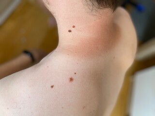 Close-up of human moles on different parts of the body. Natural skin texture with various types of moles (flat, raised, with hair). Useful for dermatology, skin cancer awareness, or medical education.