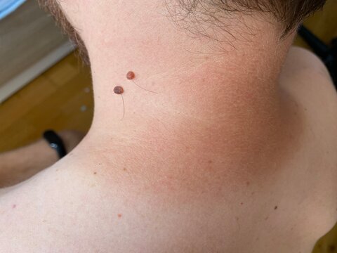 Close-up of human moles on different parts of the body. Natural skin texture with various types of moles (flat, raised, with hair). Useful for dermatology, skin cancer awareness, or medical education.