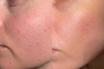 Detailed macro close-up of facial cheek skin showing redness, texture, pores, and acne scars, with...