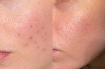Macro close-up of acne scarring and enlarged pores before and after skin treatment, ideal for...