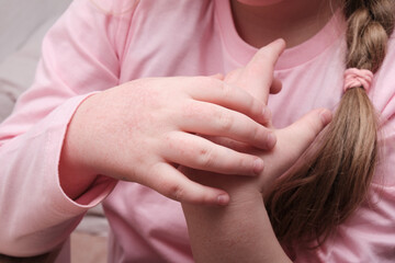 child scratching hands covered with dermatitis, skin allergy in a child, itchy redness on the skin, dry skin of the hands