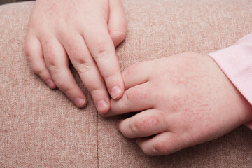 children's hands covered with atopic dermatitis, allergy on the skin of a child, redness on the skin
