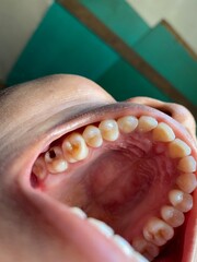 Obraz premium appearance of crooked teeth