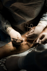 Detailed view of laser catheter placement into diseased vein. Surgeon uses real-time ultrasound to...