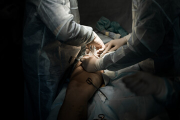  Laser treatment of varicose veins, endovenous laser coagulation EVLA