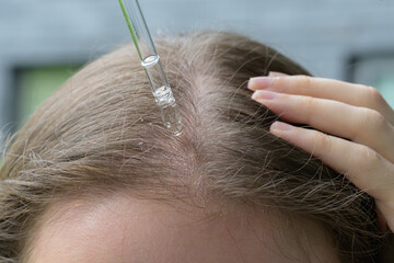 Close up of a person applying serum to dry irritated and itchy scalp with a glass dropper. Concept...
