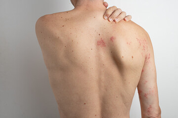 Caucasian adult male scratching his back, experiencing discomfort from herpes zoster virus. Suffering from shingles, displaying skin rash and blisters on the upper body