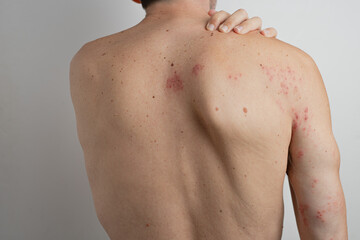 Patient showing skin rash with blisters caused by herpes zoster virus touching his painful shoulder, suffering from chickenpox virus reactivation