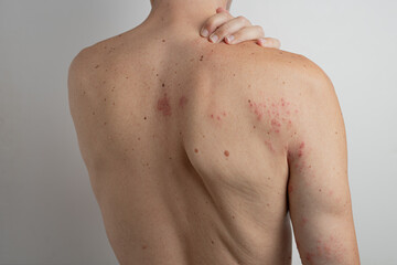 Caucasian man scratching his back and shoulder, suffering from chickenpox virus reactivation known as shingles or herpes zoster, causing itchy and painful red blisters