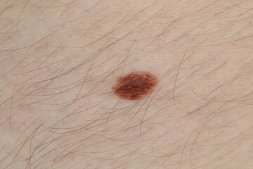 Woman with mole on her body, closeup